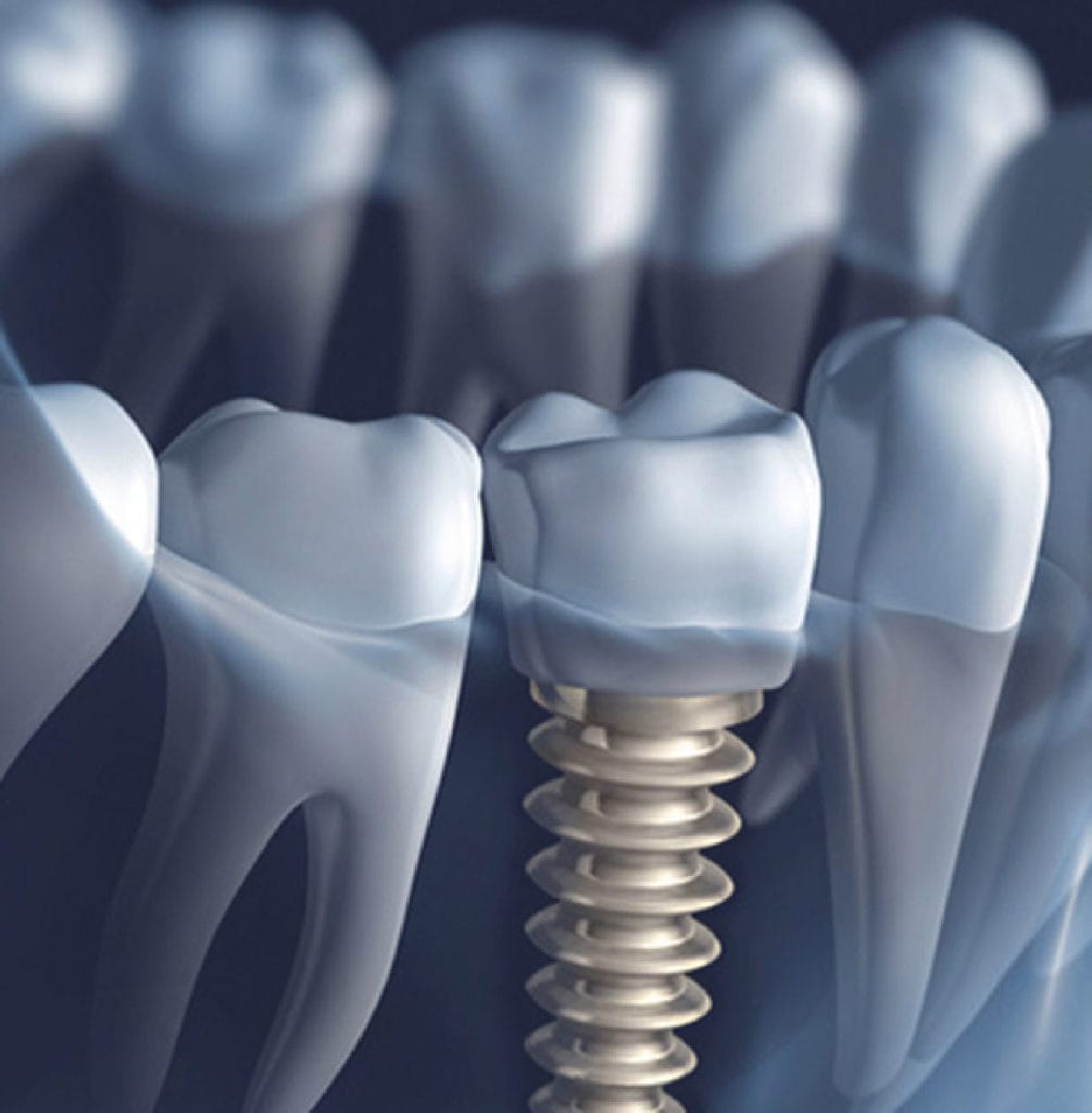 Implantologia-Studi-Montagna Verona
