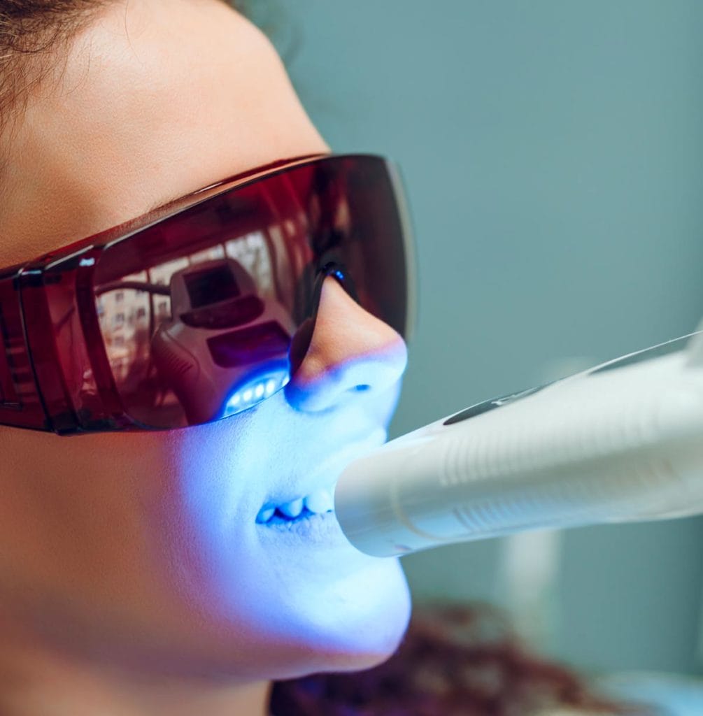 Sbiancamento-dentale-Studi-Montagna Verona