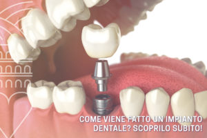 come-viene-fatto-un-impianto-dentale