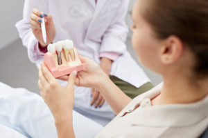 come_viene_fatto_un_impianto_dentale