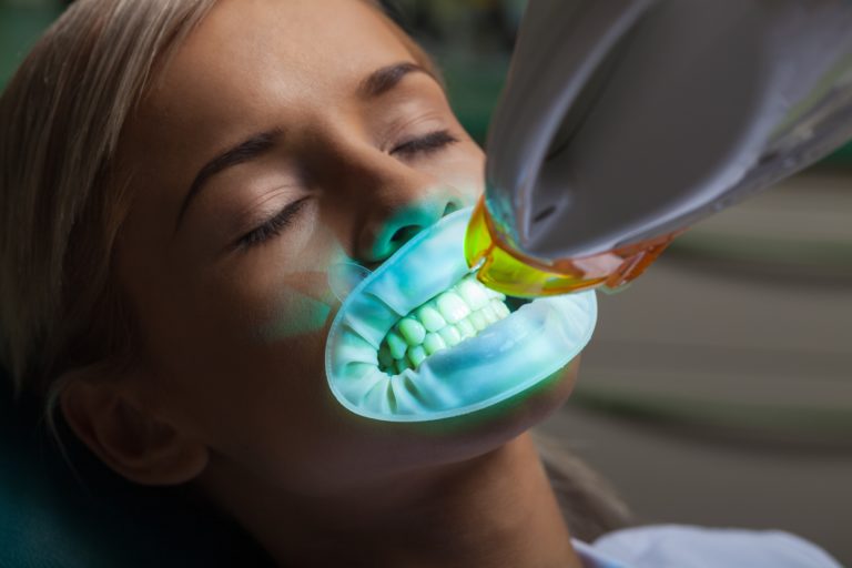 denti bianchi subito